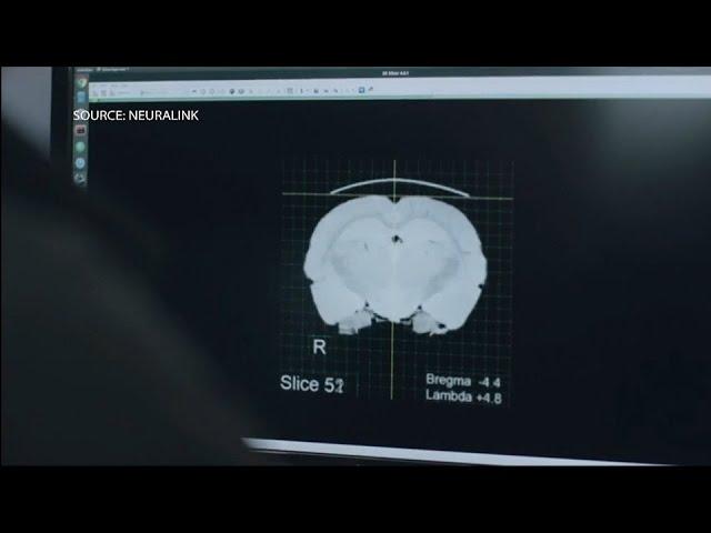 Musk’s Neuralink: First Patient Receives Brain Implant