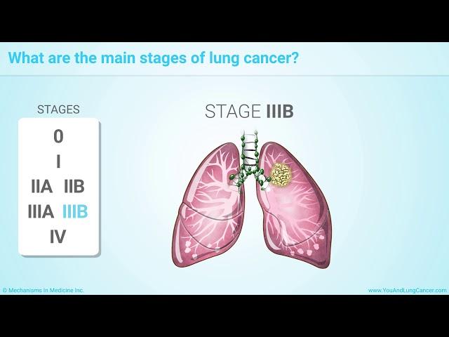 Staging of Lung Cancer