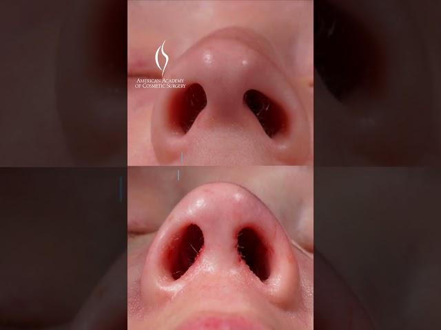 Dr. Saman's Scarless Endonasal Rhinoplasty Explained #nosesurgery #cosmeticsurgeon #medicaleducation