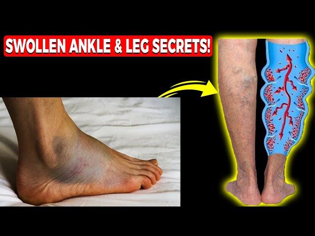 Edema: Swollen Feet, Swollen Ankles & Swollen Legs [FIX Them FAST!]