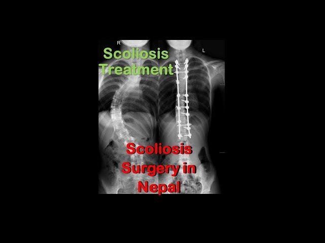 Scoliosis Surgery in Nepal. #scoliosis #surgery #scoliosistreatment #spinesurgery #spine #treatment