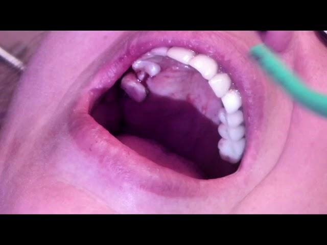 Smile Shop Dental: Dental Implant Procedure