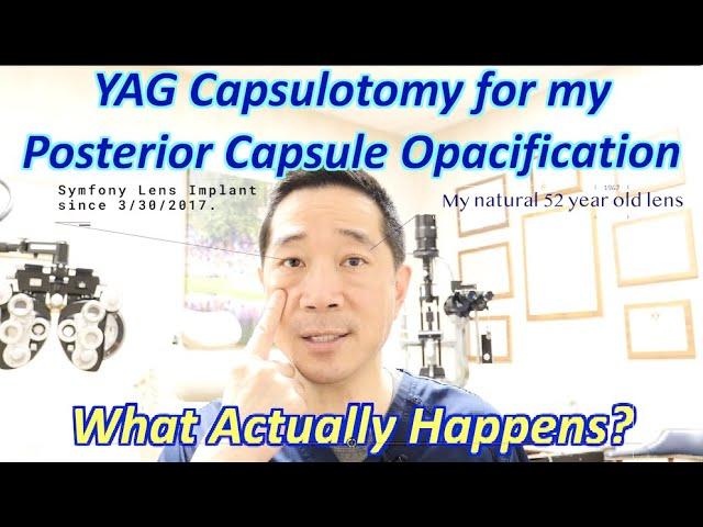 YAG capsulotomy on my own eye for treatment of posterior capsule opacification.  Surgeon's view.