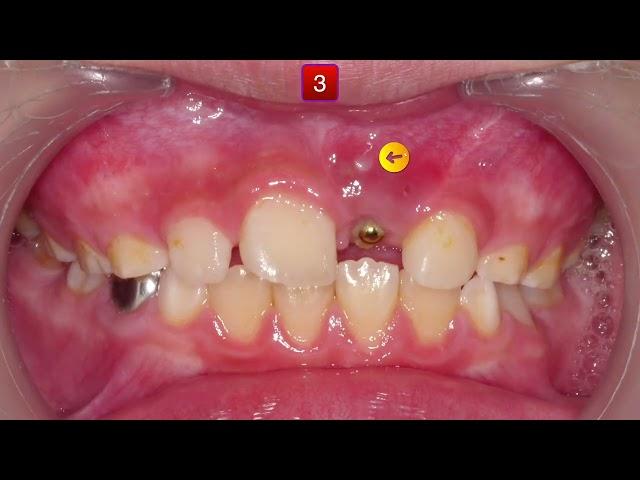 U1 Impaction Treatment｜【Chris Chang Ortho】CC813