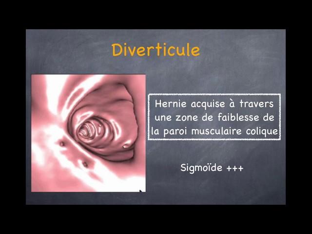 Diverticulose Colique et Sigmoïdite  - 1. Diverticule, diverticulose, diverticulite non compliquée