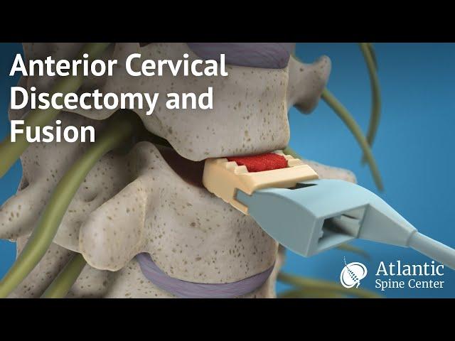 Anterior Cervical Discectomy and Fusion