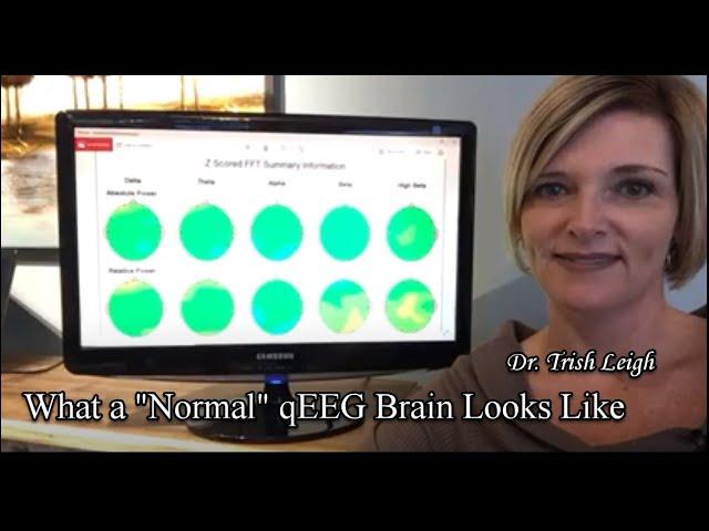 What a "Normal" qEEG Brain Map looks like.