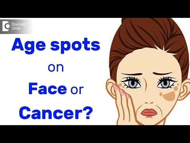 How do you know if age spots on skin are not cancerous? - Dr. Urmila Nischal