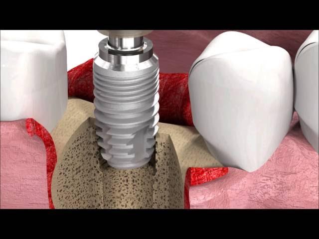 SIC invent Dental Implant Procedure: SICmax implant insertion