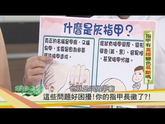 灰指甲的預防與治療方式！健康2.0