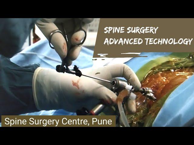 Prolapsed disc. Is Endoscopic Discectomy correct for me? Advanced Technology in spine surgery.