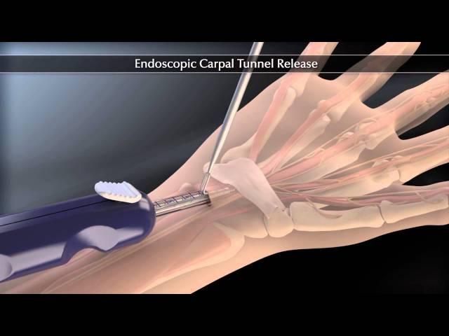 Endoscopic Carpal Tunnel Release