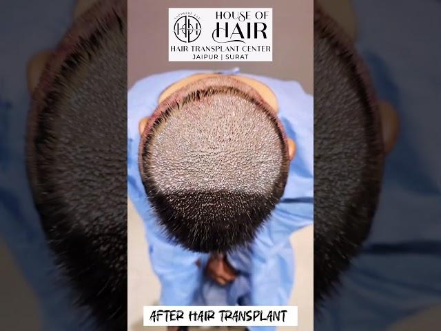 Hair Transplant in Jaipur | Best Hair Transplant Clinic in Jaipur |