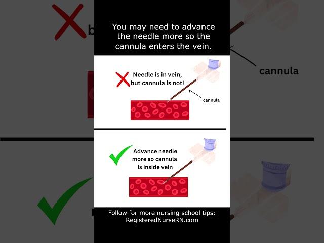 IV Cannulation Technique Tip for Nurses and Nursing Students