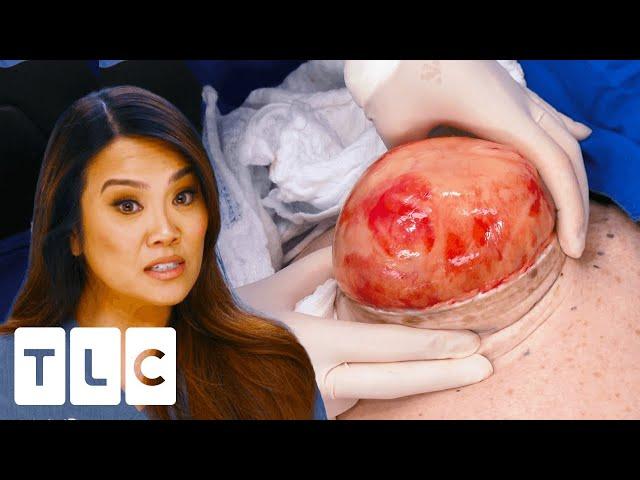 Dr. Lee Celebrates Christmas With A Huge Lipoma Removal I Dr. Pimple Popper