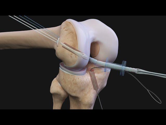 Arthrex ACL Reconstruction