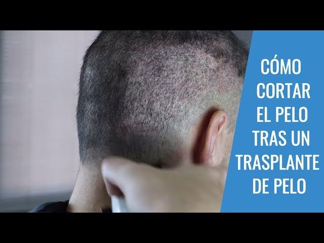 CORTE DE PELO TRAS UN TRASPLANTE DE PELO: Pautas para el corte de pelo