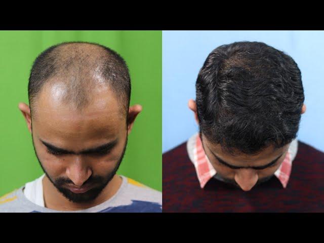 Best Hair Transplant Result 2021 || NW Grade VI || 4,479 Grafts || Regrow Clinic Haridwar