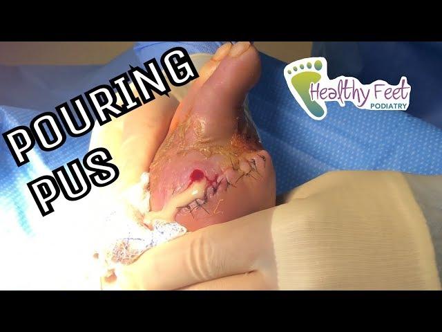 Pus Pouring Out of Amputated Toe