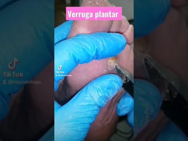 callo en una verruga #pie #planta #Podologos #podologia #callo