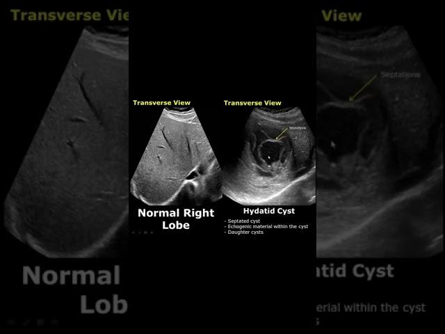 Liver Hydatid Cyst On Ultrasound | Normal Vs Abnormal USG | Abdominal Sonography #shorts