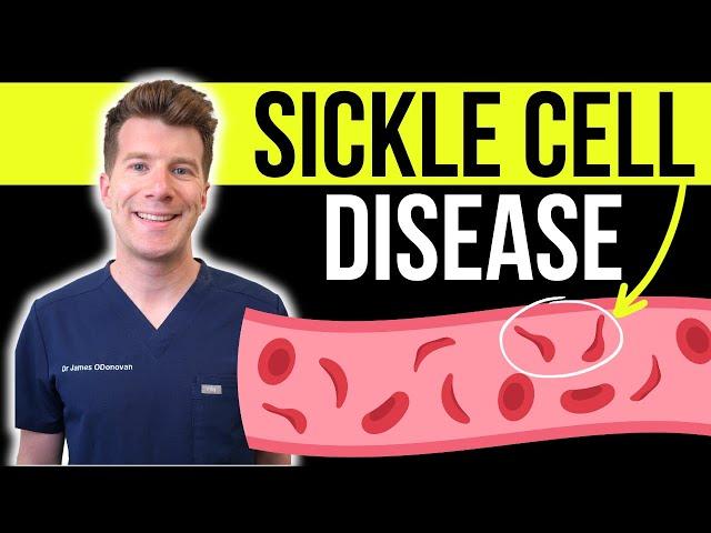 Doctor explains SICKLE CELL DISEASE | Causes, symptoms and treatment