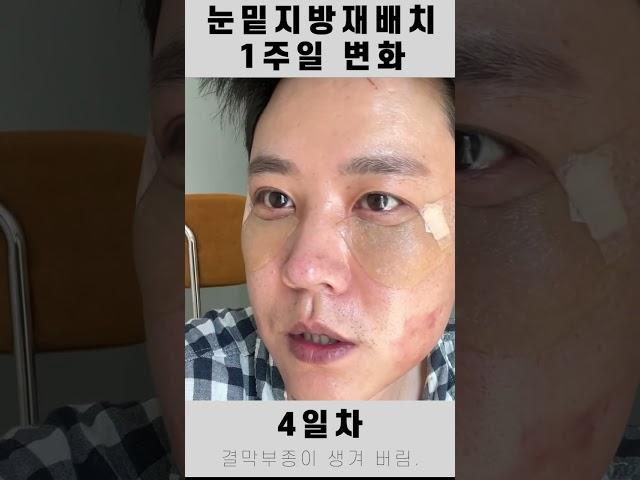 #눈밑지 #눈밑지방재배치