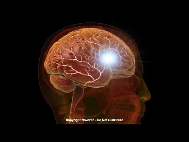 Migraine Attack - Medical Animation