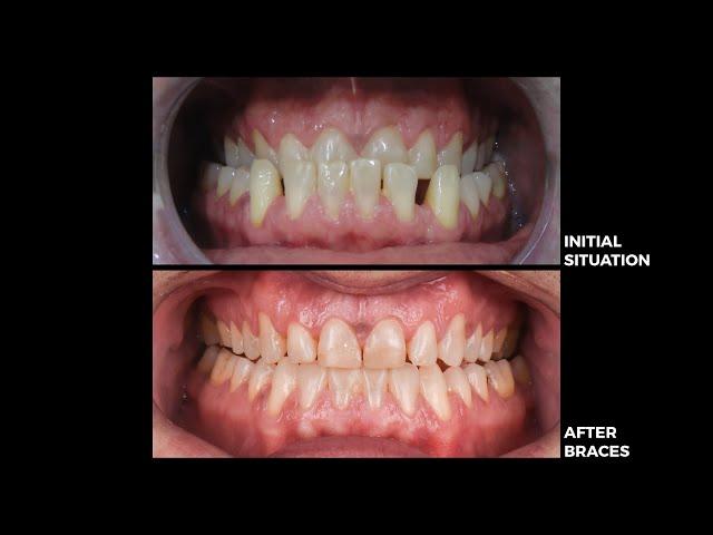 Smile Transformation with veneers