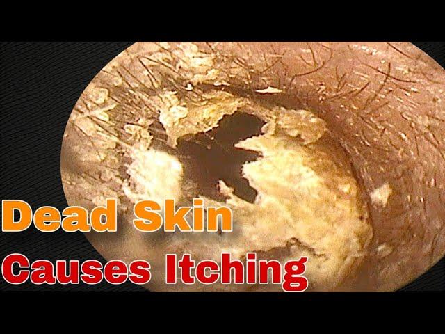 Earwax and Dead Skin Are Full On Both Sides | Doctor Anh