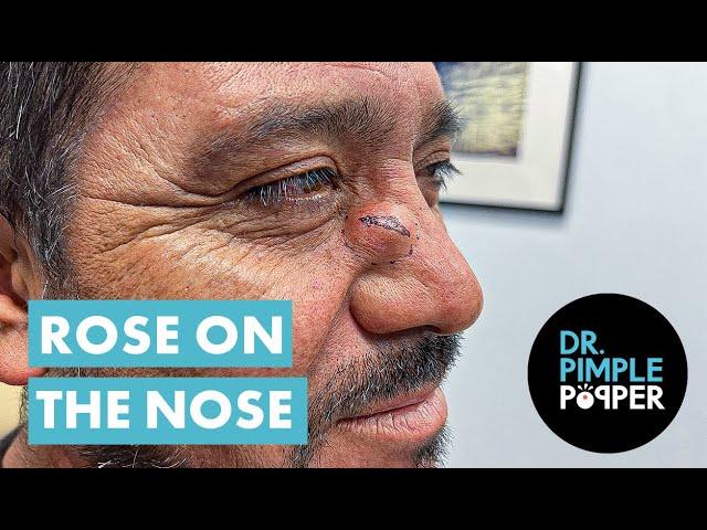 Dr Pimple Popper Opens A Rose on the Nose