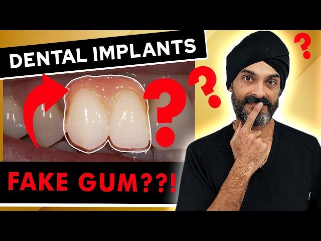 Secrets Revealed: Dental Implants with Fake Gum