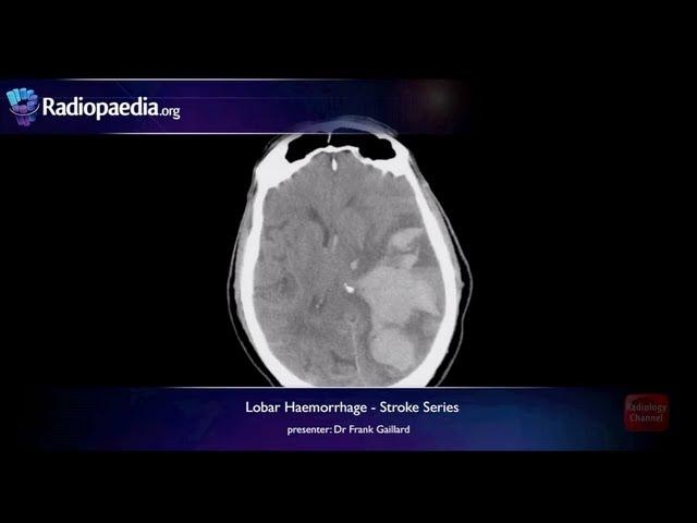 Stroke: Lobar haemorrhage - radiology video tutorial (MRI, CT)