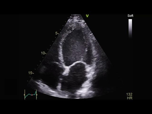 Cardiomyopathies