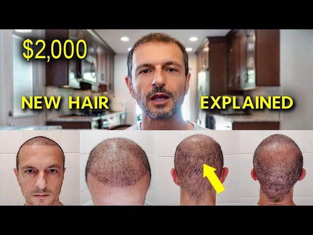 My Turkey Hair Transplant Results After 4.5 Months  Before and After