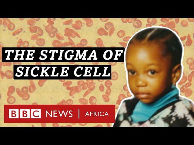 Sickle cell:  I didn't know I had the disease - BBC Africa