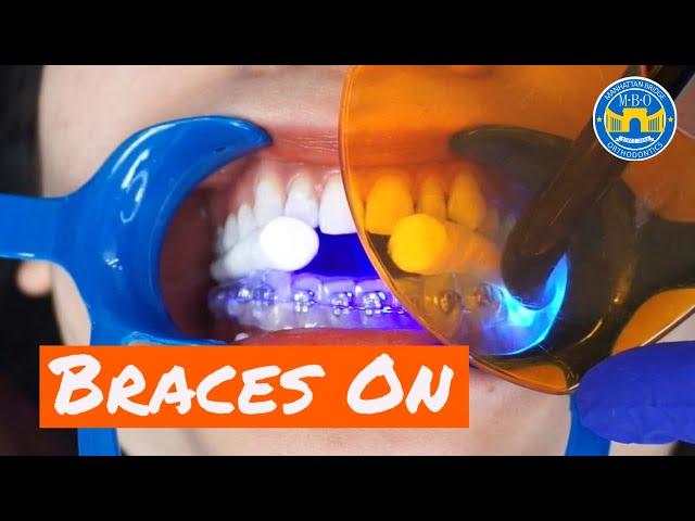 Fastest Way to Put on Braces - Indirect Bonding Technique