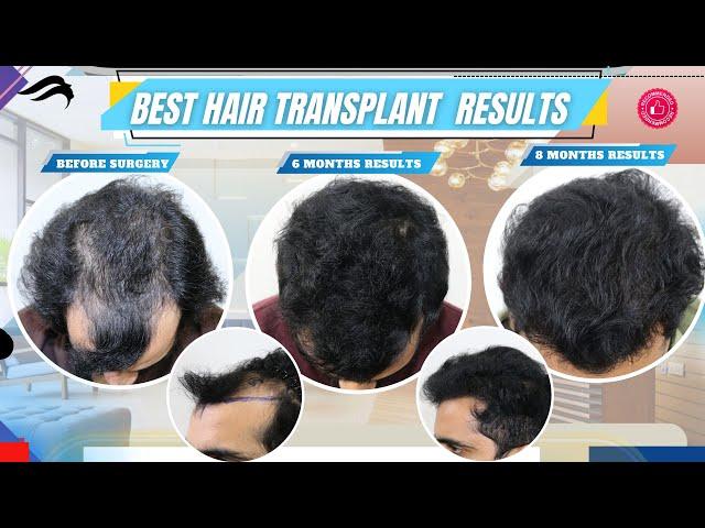 Hair Transplant In Tirupati | Best Cost Clinic Results & Surgeon Of Hair Transplant In Tirupati