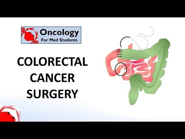 Colorectal Cancer Surgery: principles and types