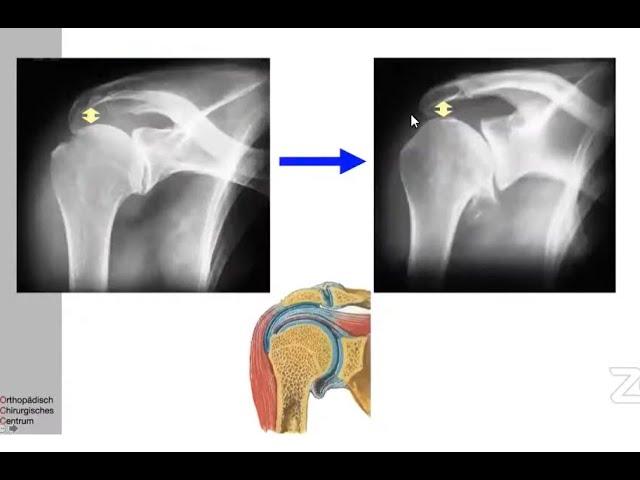 Principles of Anatomic Vs Reverse Shoulder Arthroplasty