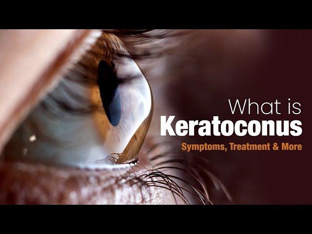 What is Keratoconus - Symptoms, Treatment and More