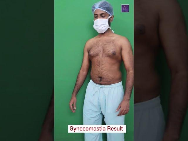 Gynecomastia Result after 21 Days | Best Gynaecomastia Surgeon in Kolkata #ytshorts