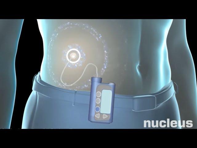 Insulin Pump
