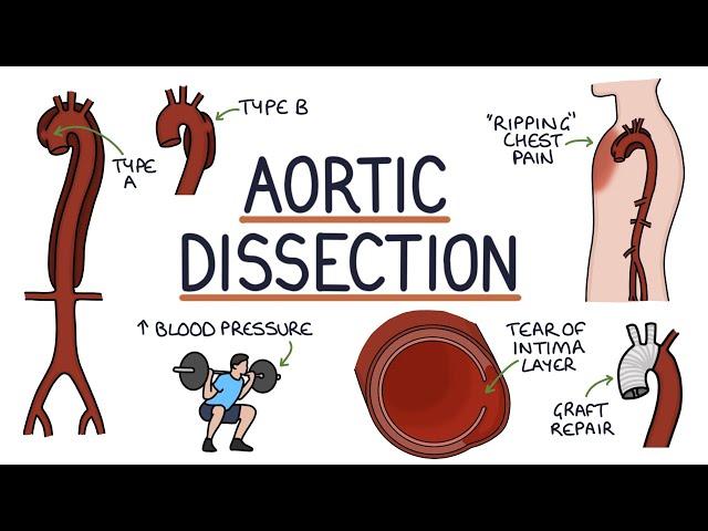 Understanding Aortic Dissection