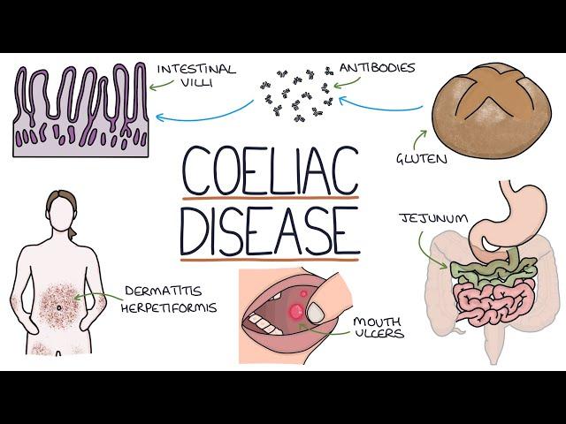 Understanding Coeliac Disease