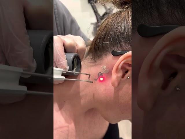 Quanta Q- Plus Laser Tattoo Removal