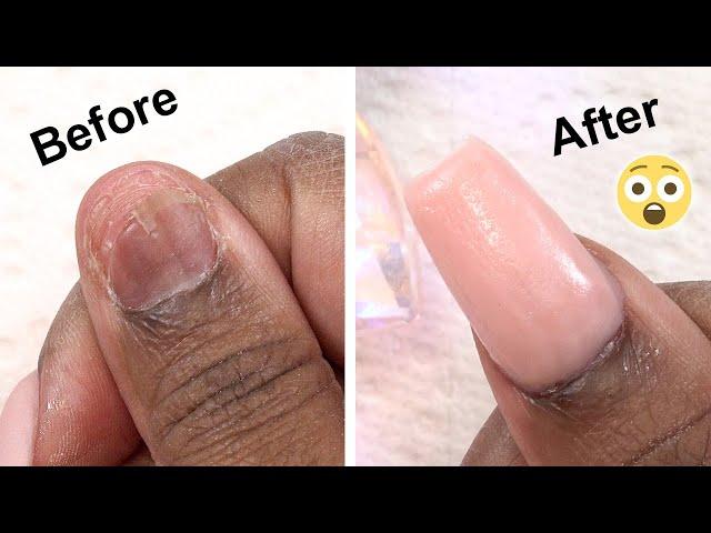 MY Real Nail Came OFF! - Here's How I Fixed It!