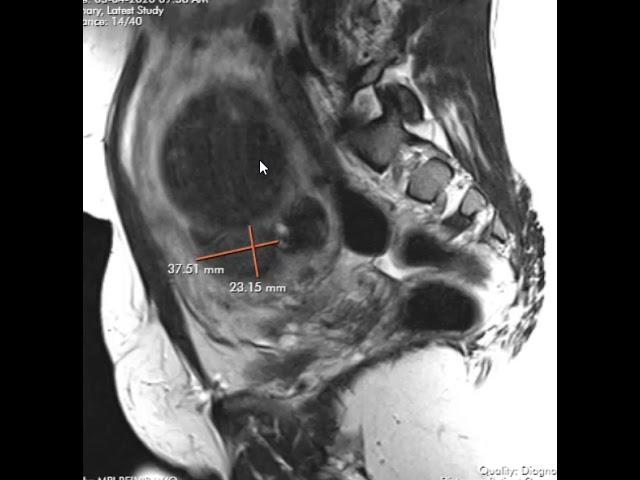 Uterine fibroids