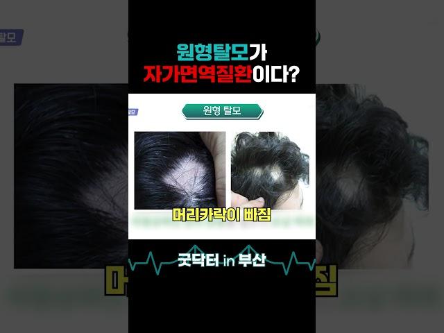 원형탈모가 자가면역질환? 함께 알아봅시다! #shorts #굿닥터인부산 #탈모 #탈모치료 #탈모원인 #원형탈모 #원형탈모원인 #자가면역질환