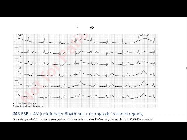 EKG in 3 Minuten [5]